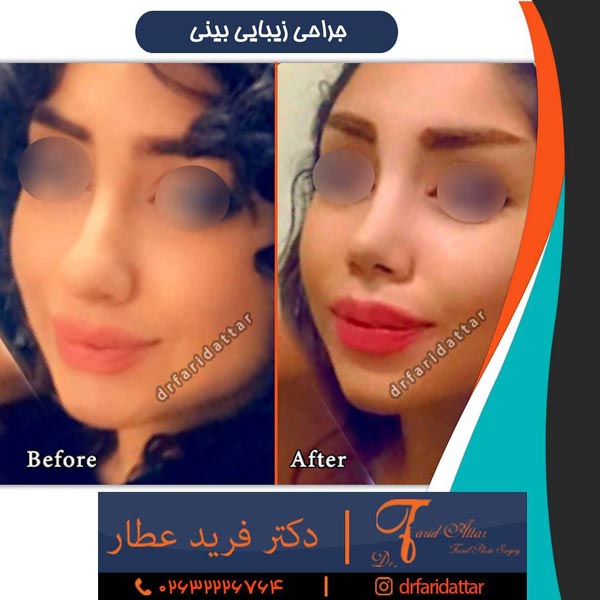 اقدامات قبل از جراحی بینی