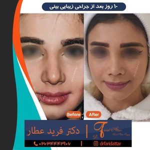 جراحی بینی