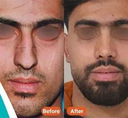 عمل بینی نیمه فانتزی مردانه