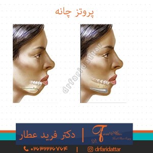 پروتز چانه