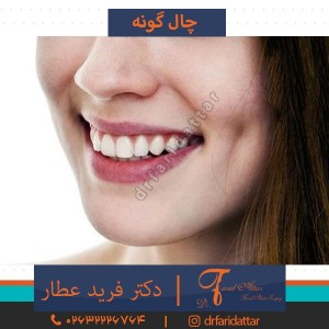 چاله گونه