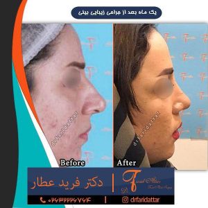 جراحی بینی طبیعی