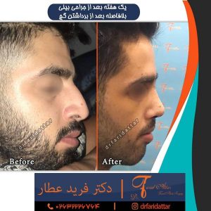 عکس بینی عمل شده طبیعی