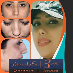 جراحی بینی فانتزی