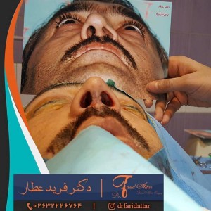 جراحی بینی ترمیمی