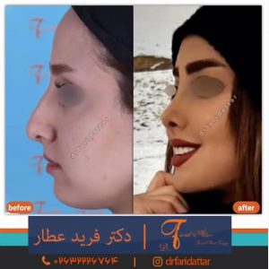 جراحی بینی کج