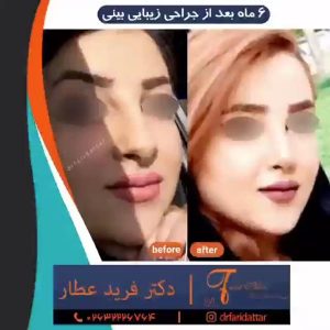 جراحی بینی کج