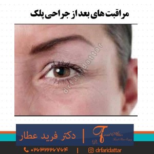 مراقبت های بعد از جراحی پلک