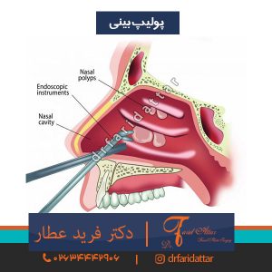 پولیپ بینی