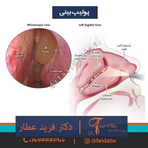 پولیپ بینی