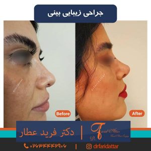 انحراف بینی