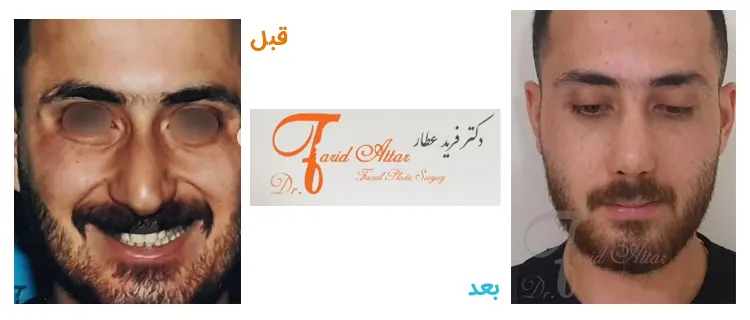 جراحی بینی مردانه در کرج