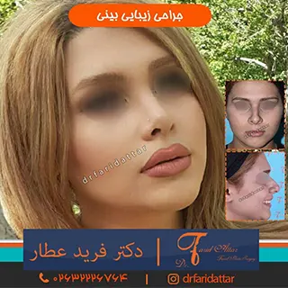 جراحی بینی بسته در البرز