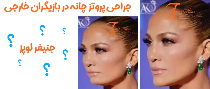 جراحی پروتز چانه در کرج