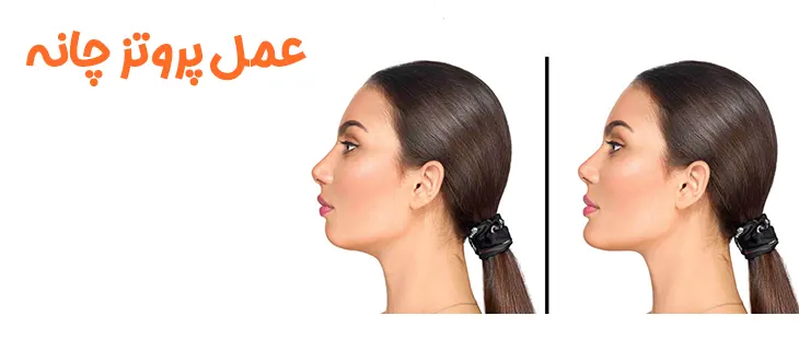 عمل پروتز چانه در کرج