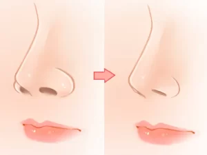 جراحی کوچک کردن پره های بینی